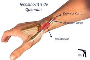 Fisioterapeuta Sevilla tenosinovitis