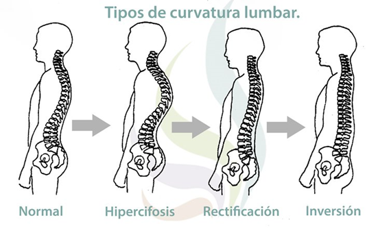 curvatura lumbar lateral