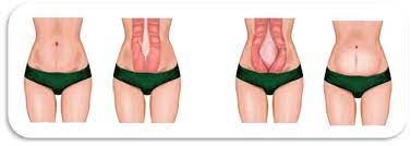 Fisioterapia Sevilla diastasis abdominal