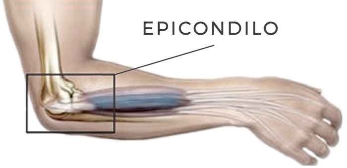 epicondilo