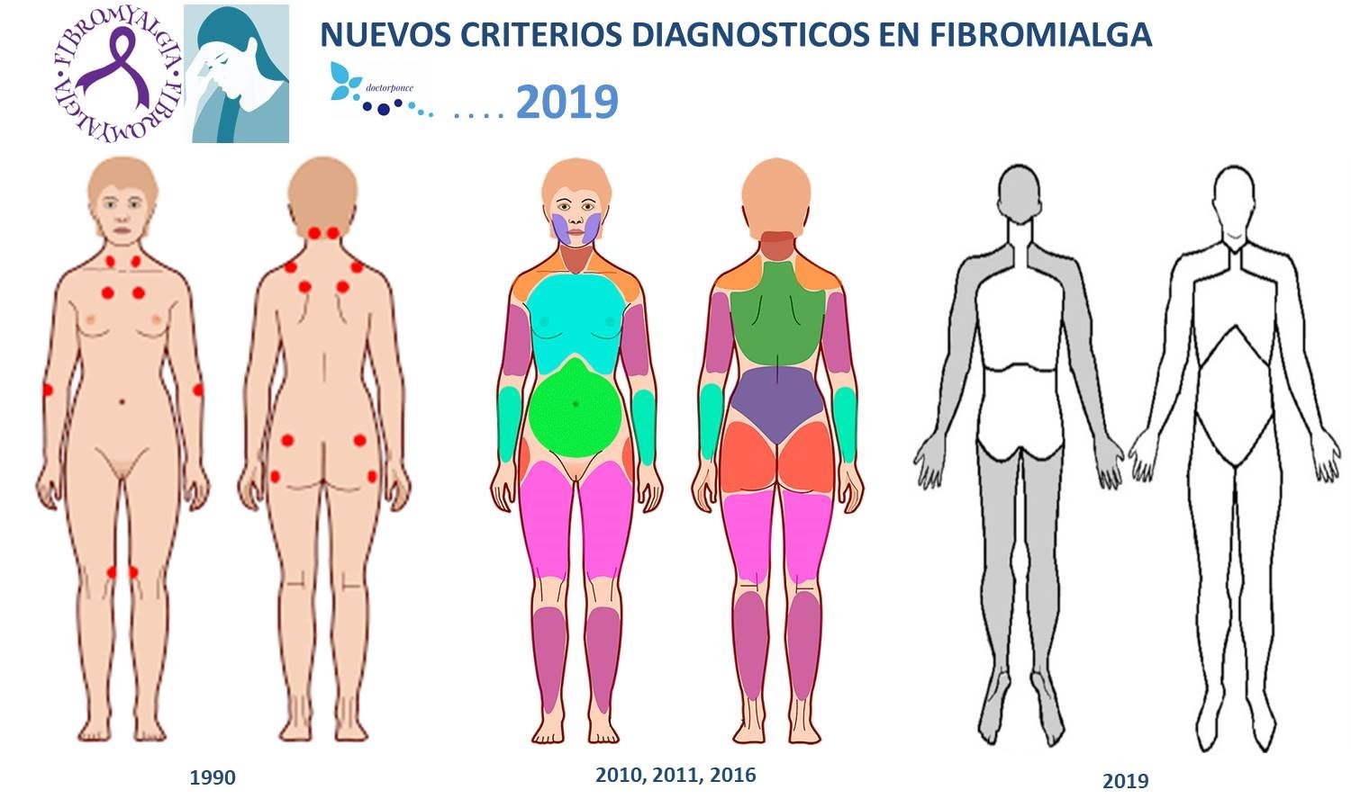 fibromialgia criterios actualizados