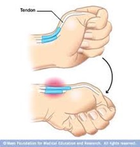 fisioterapia sevilla tenosinovitis